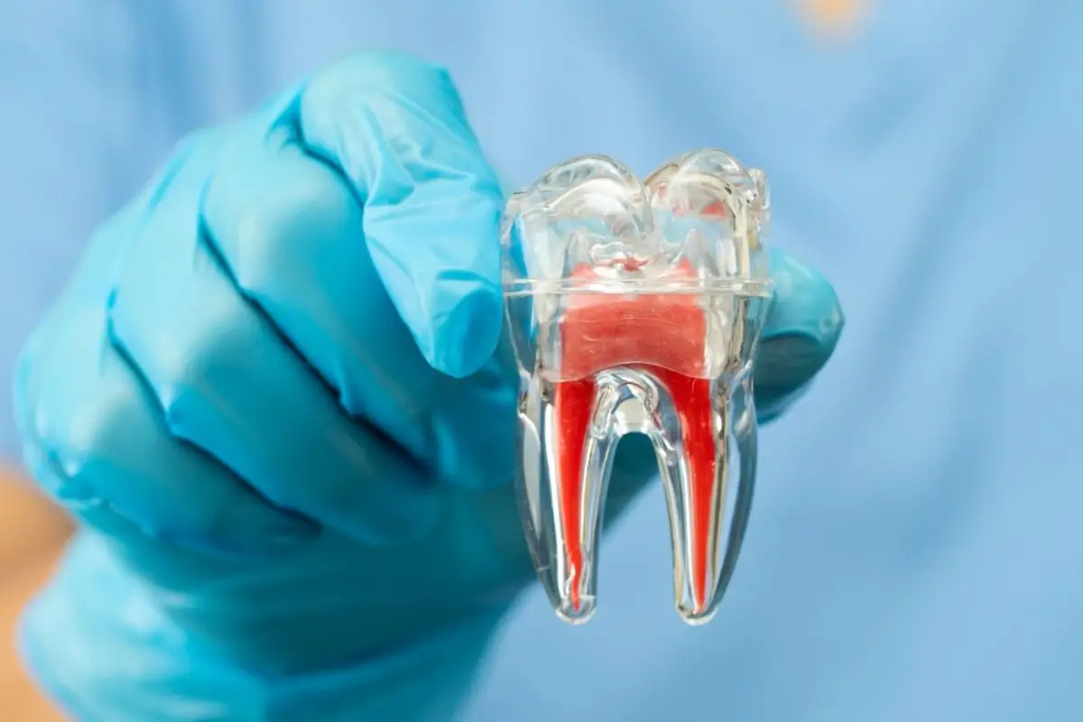 Root Canals